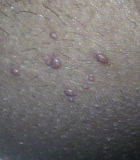 Molusco contagioso